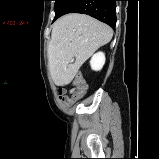 File:Ampullary carcinoma (Radiopaedia 56396-63056 D 23).jpg