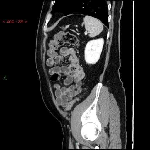 Ampullary carcinoma (Radiopaedia 56396-63056 D 85).jpg