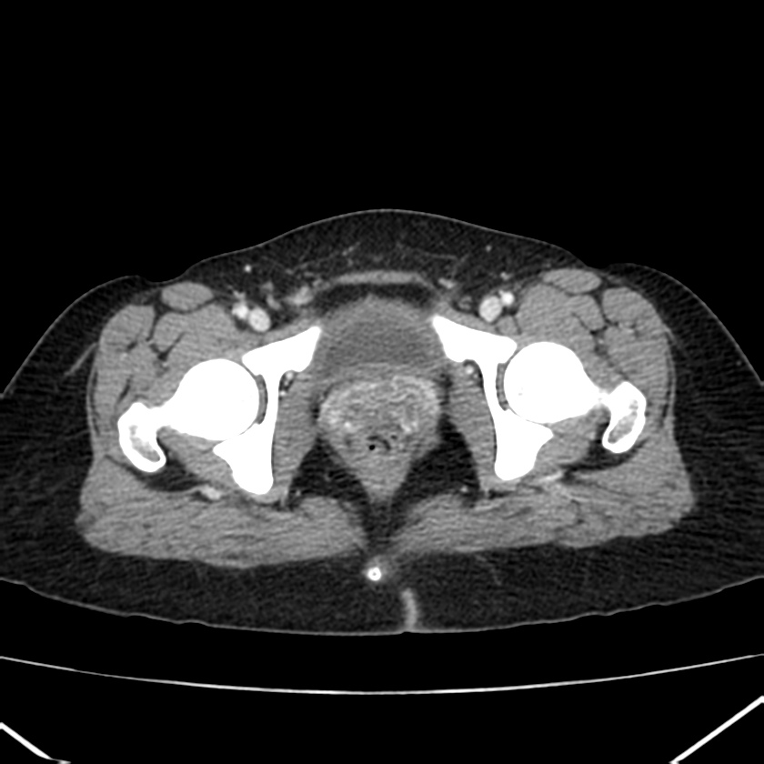 Ampullary tumor (Radiopaedia 22787-22816 C 68).jpg