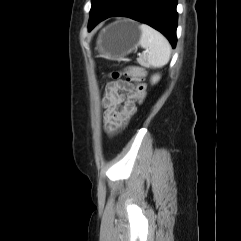 Ampullary tumor (Radiopaedia 22787-22816 D 47).jpg
