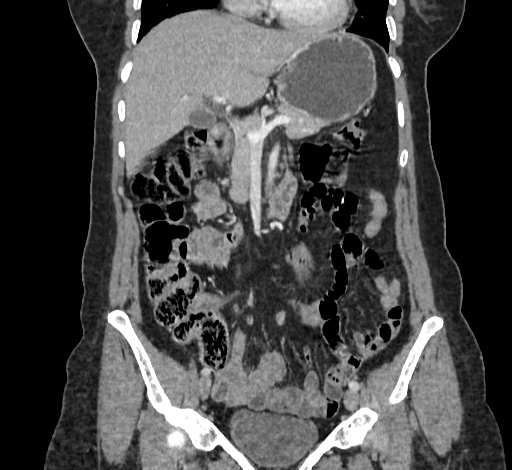 Ampullary tumor (Radiopaedia 60333-67998 B 31).jpg