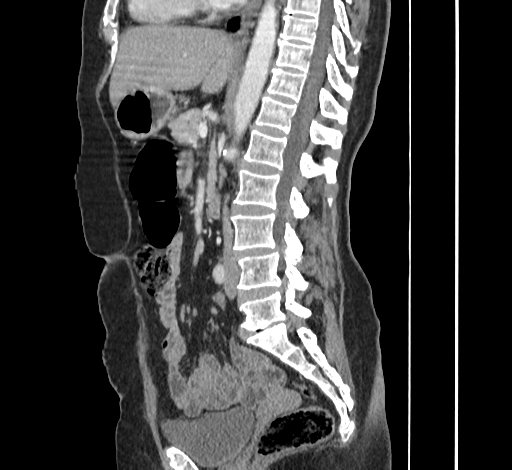 File:Ampullary tumor (Radiopaedia 60333-67998 C 29).jpg