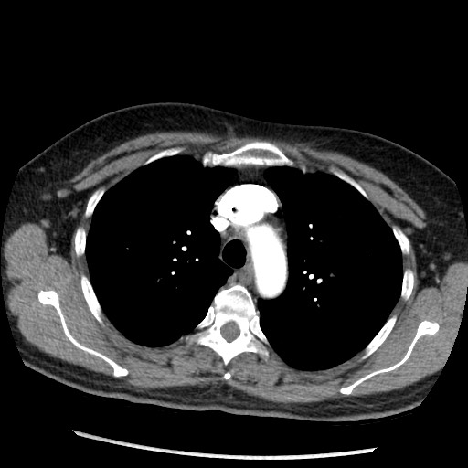 Amyloidosis - bronchial and diffuse nodular pulmonary involvement (Radiopaedia 60156-67745 A 15).jpg