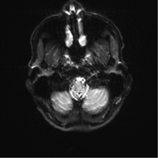 Anaplastic astrocytoma IDH mutant (Radiopaedia 50046-55341 Axial DWI 3).png