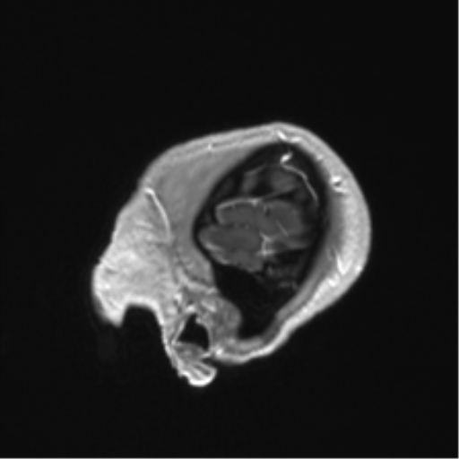 Anaplastic astrocytoma IDH mutant (Radiopaedia 50046-55341 Sagittal T1 C+ 11).png