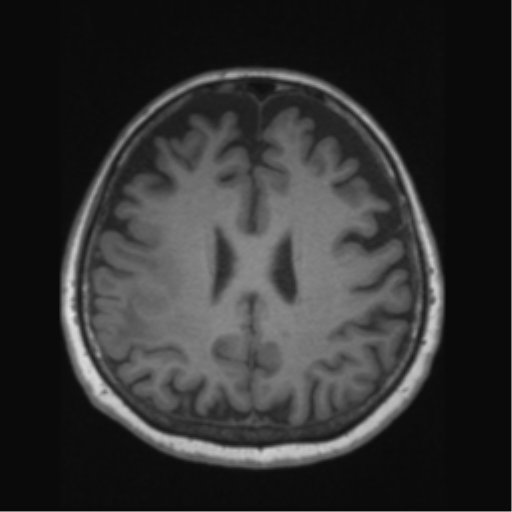File:Anaplastic astrocytoma IDH wild-type (pseudoprogression) (Radiopaedia 42209-45276 Axial T1 100).png