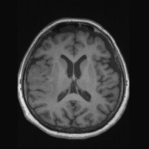 File:Anaplastic astrocytoma IDH wild-type (pseudoprogression) (Radiopaedia 42209-45276 Axial T1 88).png