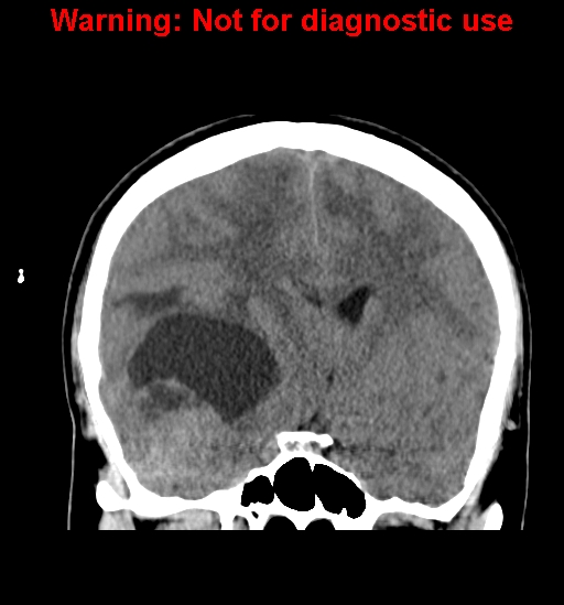 File:Anaplastic ganglioglioma (Radiopaedia 44921-48815 Coronal non-contrast 18).jpg