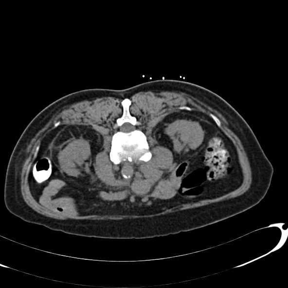 File:Anaplastic lymphoma - with CT biopsy (Radiopaedia 21643-21602 Axial non-contrast 28).jpg