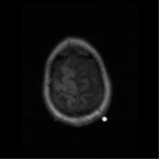 File:Anaplastic meningioma with recurrence (Radiopaedia 34452-35783 Axial T1 20).png