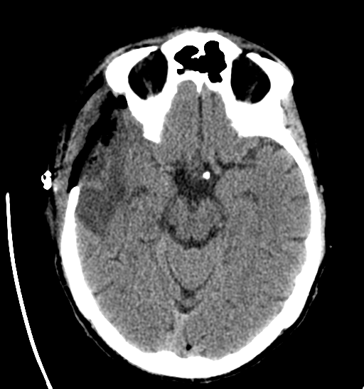 File:Anaplastic meningioma with recurrence (Radiopaedia 34452-35786 Axial non-contrast 13).png