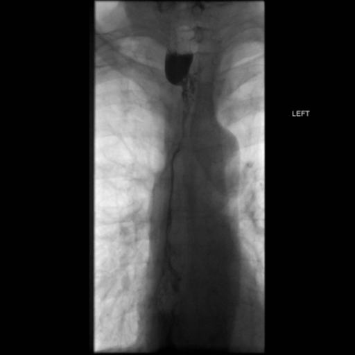File:Anastomotic stricture post Ivor Lewis esophagectomy (Radiopaedia 47937-52715 B 26).png