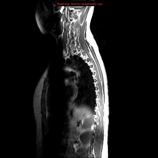 File:Aneurysmal bone cyst (Radiopaedia 9419-10103 Sagittal T1 12).jpg