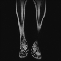 File:Aneurysmal bone cyst - tibia (Radiopaedia 22343-22367 Coronal T2 5).jpg