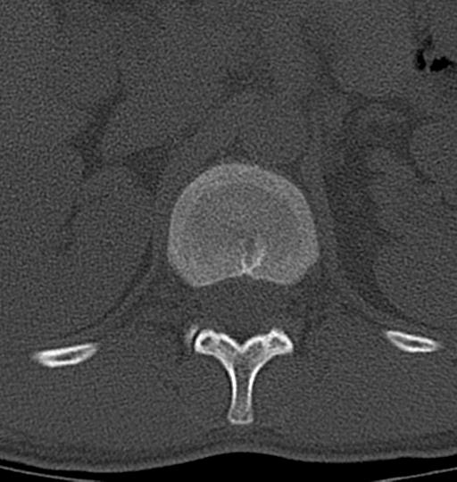 Aneurysmal bone cyst T11 (Radiopaedia 29294-29721 Axial bone window 58).jpg