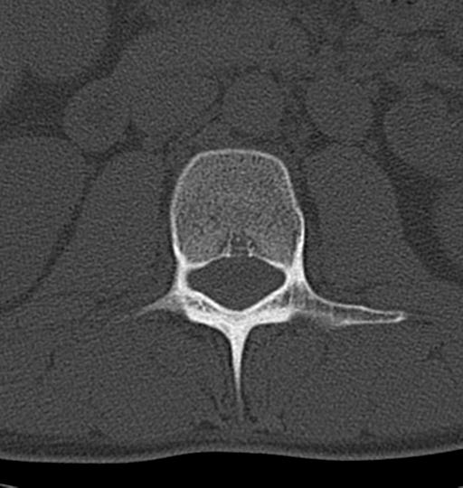 Aneurysmal bone cyst T11 (Radiopaedia 29294-29721 Axial bone window 77).jpg