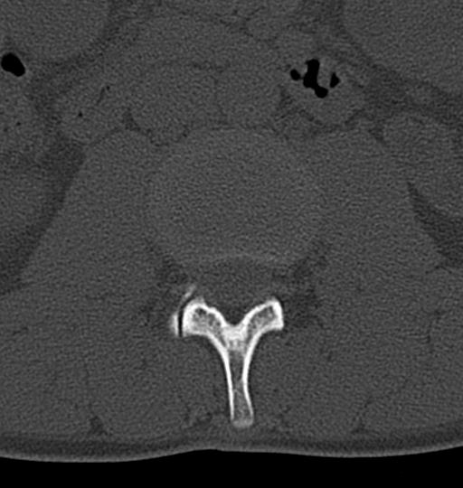 Aneurysmal bone cyst T11 (Radiopaedia 29294-29721 Axial bone window 82).jpg