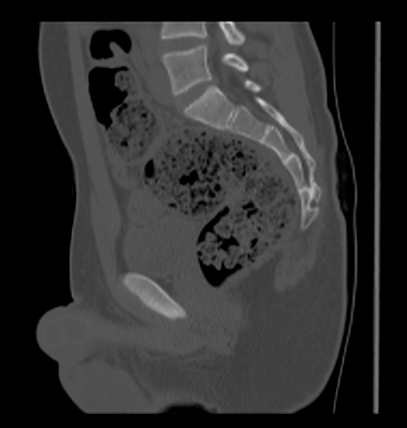 Aneurysmal bone cyst of ischium (Radiopaedia 25957-26094 Sagittal bone window 40).png
