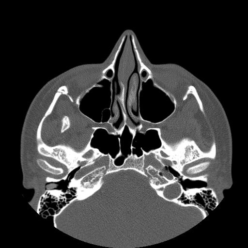 Aneurysmal bone cyst of the mandible (Radiopaedia 43280-46823 Axial bone window 145).jpg