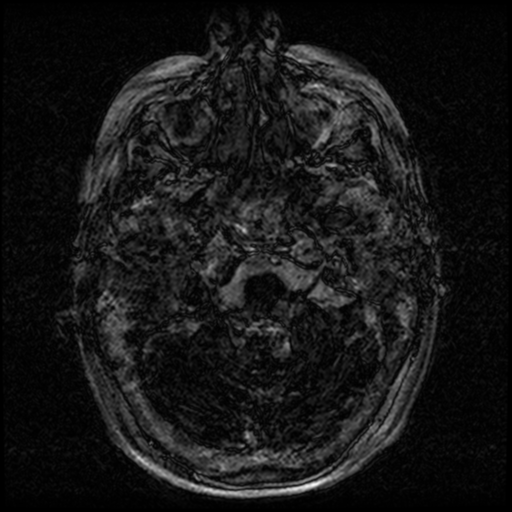 Angioinvasive aspergillosis in the pituitary fossa (Radiopaedia 39676-42010 Ax 3D FIESTA VOLUME 4).png