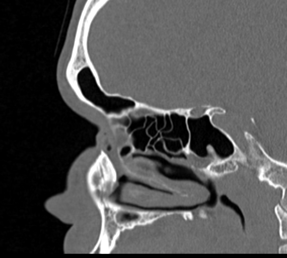 Angular epidermoid cyst (Radiopaedia 46908-51439 Sagittal bone window 31).png