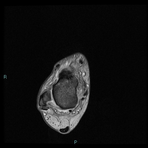 Ankle ganglion cyst (Radiopaedia 62809-71162 Axial Gradient Echo 55).jpg