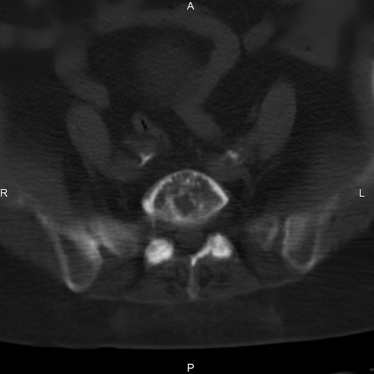 Ankylosing spondylitis (Radiopaedia 8748-9556 Axial bone window 47).jpg