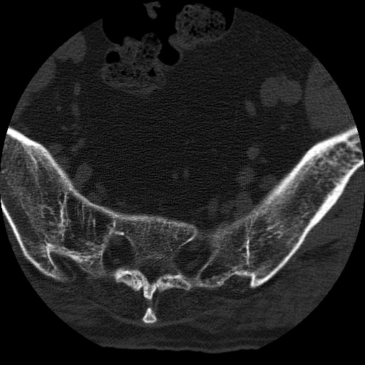 Ankylosing spondylitis complicated by fracture-dislocation (Radiopaedia 33583-34674 Axial non-contrast 180).jpg