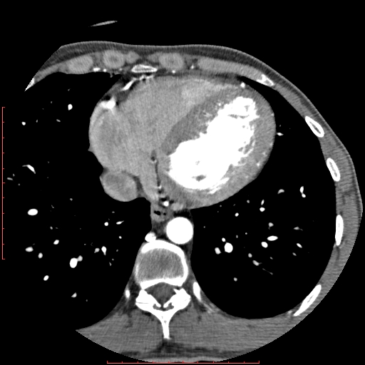 Anomalous left coronary artery from the pulmonary artery (ALCAPA) (Radiopaedia 70148-80181 A 269).jpg