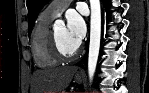 File:Anomalous left coronary artery from the pulmonary artery (ALCAPA) (Radiopaedia 70148-80181 C 140).jpg