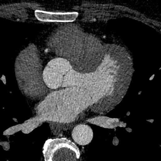 File:Anomalous origin of the left coronary artery with malignant course (Radiopaedia 77842-90126 C 114).jpeg