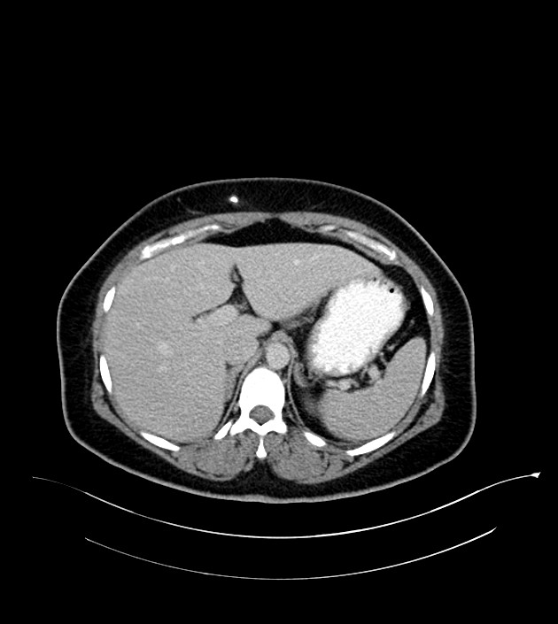 Anterior abdominal wall CSF pseudocyst (CSFoma) (Radiopaedia 79453-92571 A 25).jpg