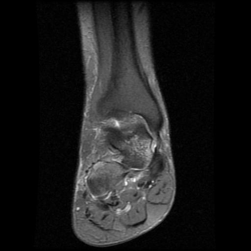 File:Anterior calcaneal process fracture (Radiopaedia 71377-81705 Coronal PD fat sat 5).jpg