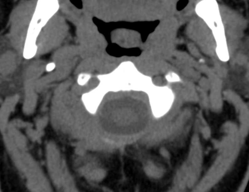 Anterior cervical postdiscectomy arthrodesis (Radiopaedia 32678-33646 Axial non-contrast 19).jpg