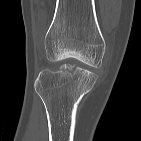 File:Anterior cruciate ligament avulsion fracture (Radiopaedia 58939-66194 Coronal bone window 8).jpg