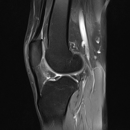 File:Anterior cruciate ligament full thickness tear (Radiopaedia 66268-75467 Sagittal PD fat sat 15).jpg
