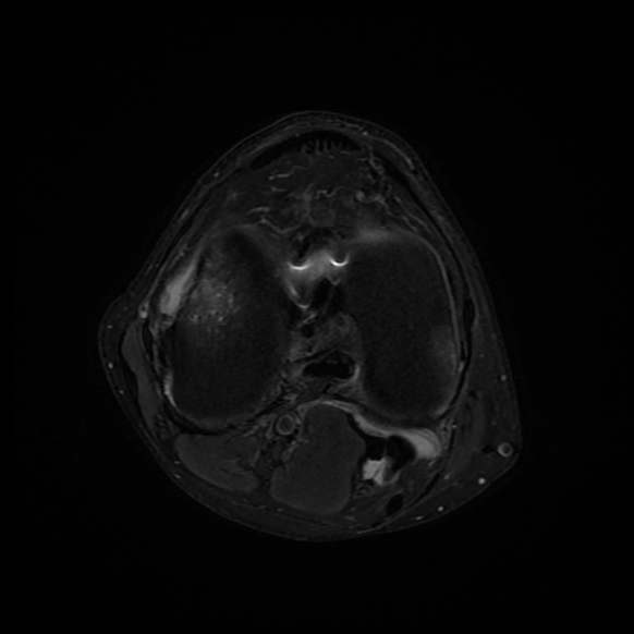 File:Anterior cruciate ligament graft tear and bucket-handle tear of medial meniscus (Radiopaedia 75867-87254 Axial PD fat sat 12).jpg
