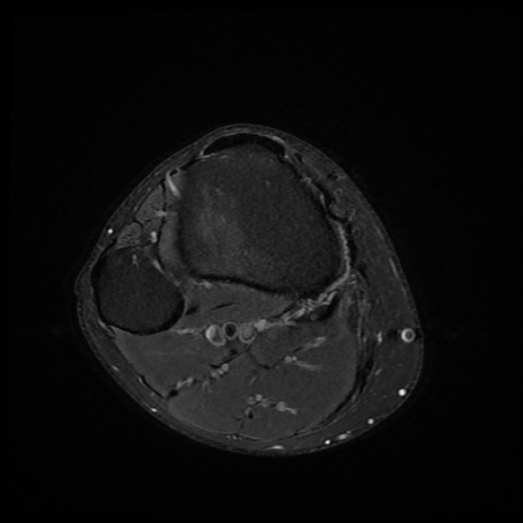 File:Anterior cruciate ligament graft tear and bucket-handle tear of medial meniscus (Radiopaedia 75867-87254 Axial PD fat sat 2).jpg
