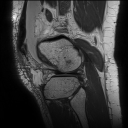 Anterior cruciate ligament rupture with Segond fracture (Radiopaedia 69043-78806 Sagittal PD 146).jpg