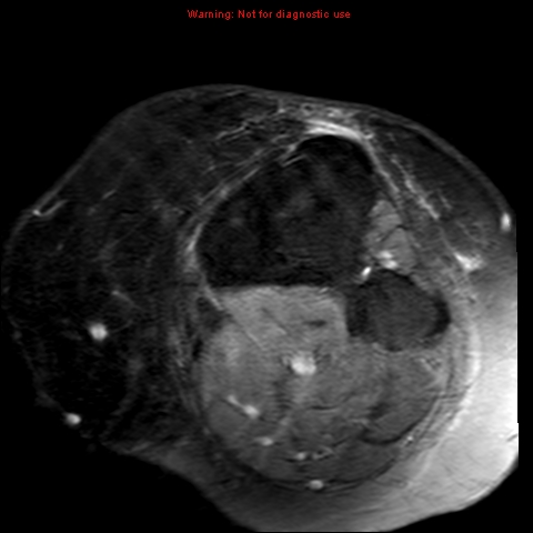 File:Anterior cruciate ligament tear (Radiopaedia 12329-12612 Axial T2 fat sat 2).jpg