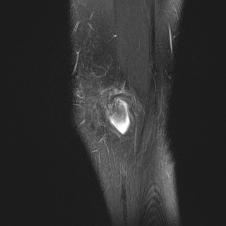 File:Anterior cruciate ligament tear - pediatric (Radiopaedia 62152-70260 Sagittal PD fat sat 6).jpg