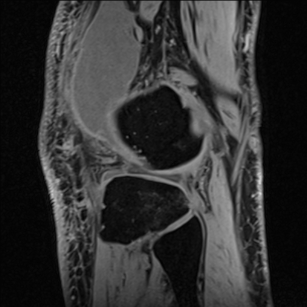 Anterior cruciate ligament tear - ramp lesion (Radiopaedia 71883-82322 Sagittal T1 vibe 29).jpg