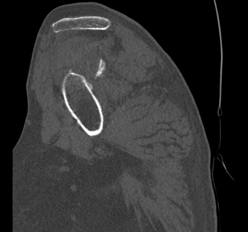 Anterior glenohumeral dislocation with Hill-Sachs lesion (Radiopaedia 62877-71249 Sagittal bone window 25).jpg