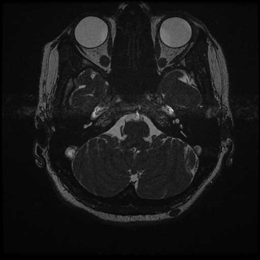 Anterior inferior cerebellar artery vascular loop - type II (Radiopaedia 70991-81209 Axial 3D FIESTA 53).jpg