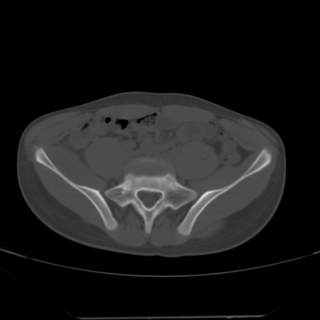 Anterior inferior iliac spine avulsion fracture (Radiopaedia 49469-54627 Axial bone window 6).jpg