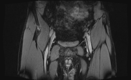 Anterior inferior iliac spine avulsion fracture (Radiopaedia 81312-95000 G 91).jpg