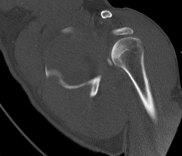 File:Anterior shoulder dislocation with Hill-Sachs and bony Bankart lesions (Radiopaedia 40424-42974 Coronal bone window 25).png