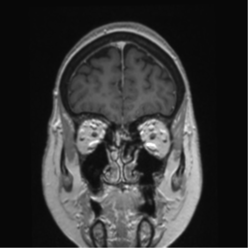 Anterior temporal pole cysts (Radiopaedia 46629-51102 Coronal T1 C+ 140).png