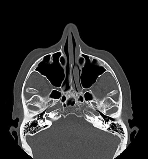 File:Anterior temporomandibular joint dislocation (Radiopaedia 59430-66784 Axial non-contrast 12).jpg