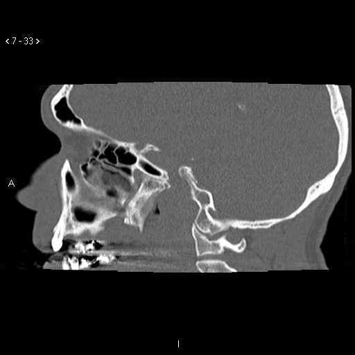 File:Antrochoanal Polyp (Radiopaedia 70510-80631 Sagittal bone window 23).jpg